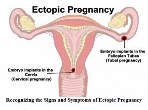 West Virginia University Medical School now teaches residents how to diagnose and treat ectopic pregnancy