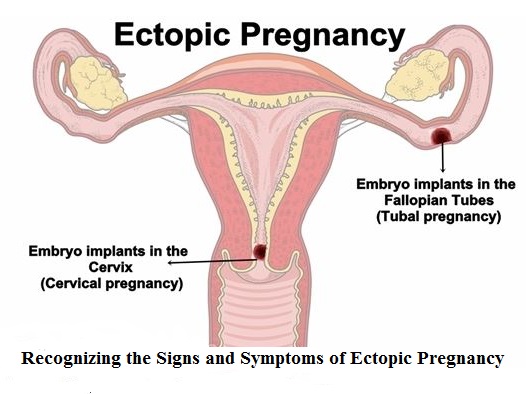 Почему эндометрий тонкий. Шеечная внематочная беременность. Шеечная внематочная беременность УЗИ. Перешеечно шеечная беременность.